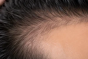 Hair Transplant Cost in Malaysia