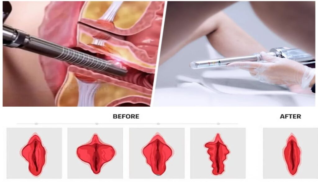 Laser Vaginal Tightening Cost