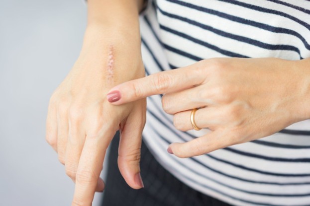 Scar treatment methods