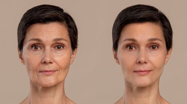 Comparing Profhilo with Other Treatments