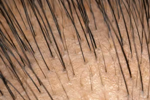 Hair Restoration