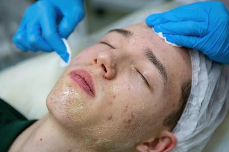 acne scar treatment in kuala lumpur
